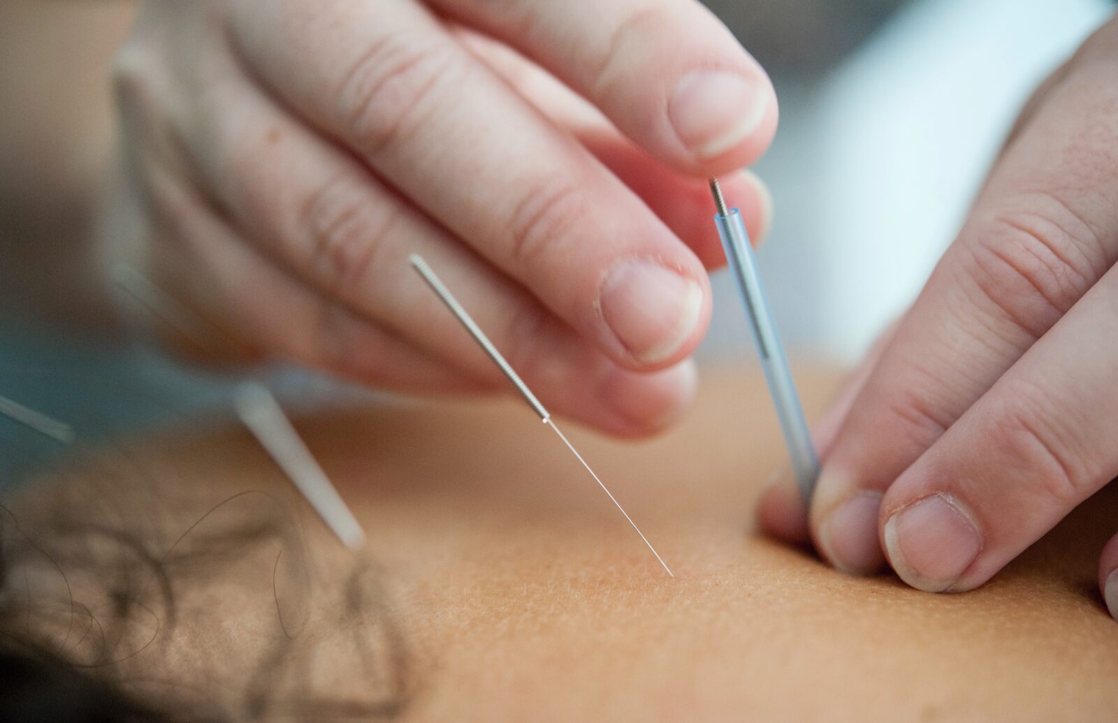 Acupuncture or Dry Needling at Back On Track Chiropractic + Acupuncture by Dr. Callan Martin DC, CCSP Overland Park, KS 66210 Chiropractor