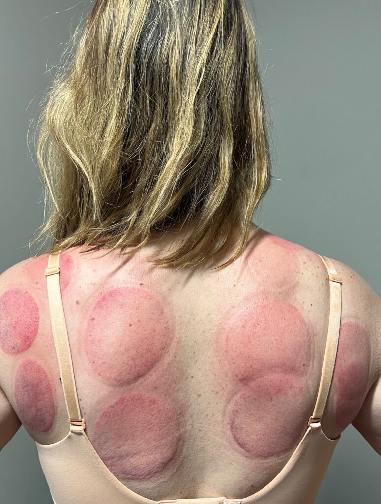 Cupping Marks on patient at Back On Track Chiropractic and Acupuncture