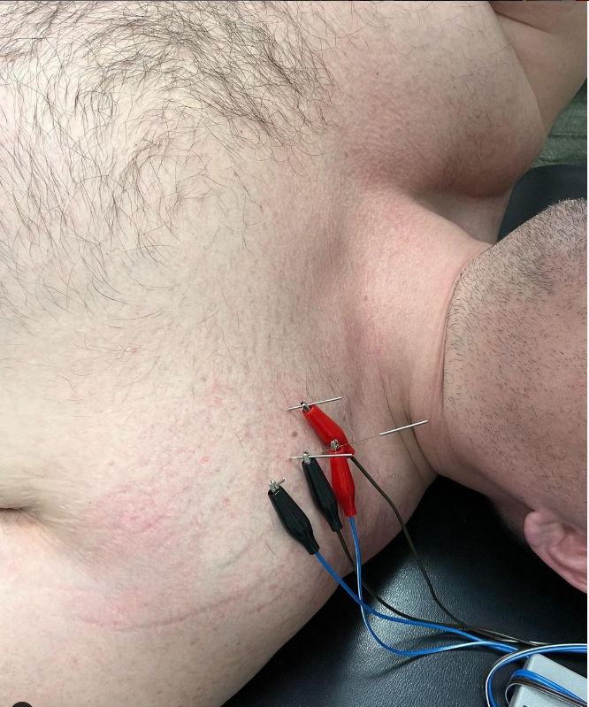 Dry Needling with Electrical Stimulation on Shoulder.  Treated by Back On Track Chiropractic and Acupuncture in Overland Park